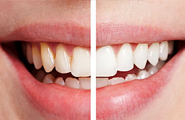 laser-teeth-whitening-featured