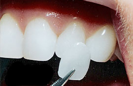 veneers-featured